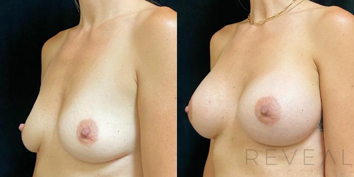 Before & After Breast Augmentation Case 586 View #2 View in San Jose, CA