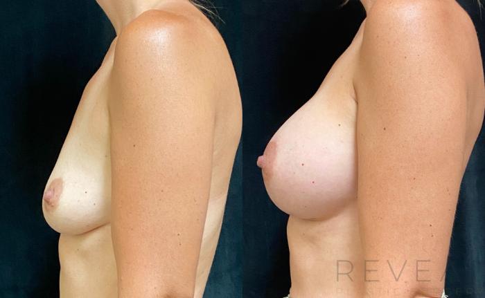 Before & After Breast Augmentation Case 586 View #3 View in San Jose, CA