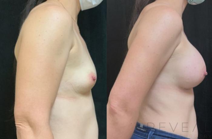 Before & After Breast Augmentation Case 588 View #1 View in San Jose, CA