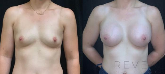 Before & After Breast Augmentation Case 588 View #2 View in San Jose, CA