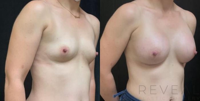 Before & After Breast Augmentation Case 588 View #3 View in San Jose, CA