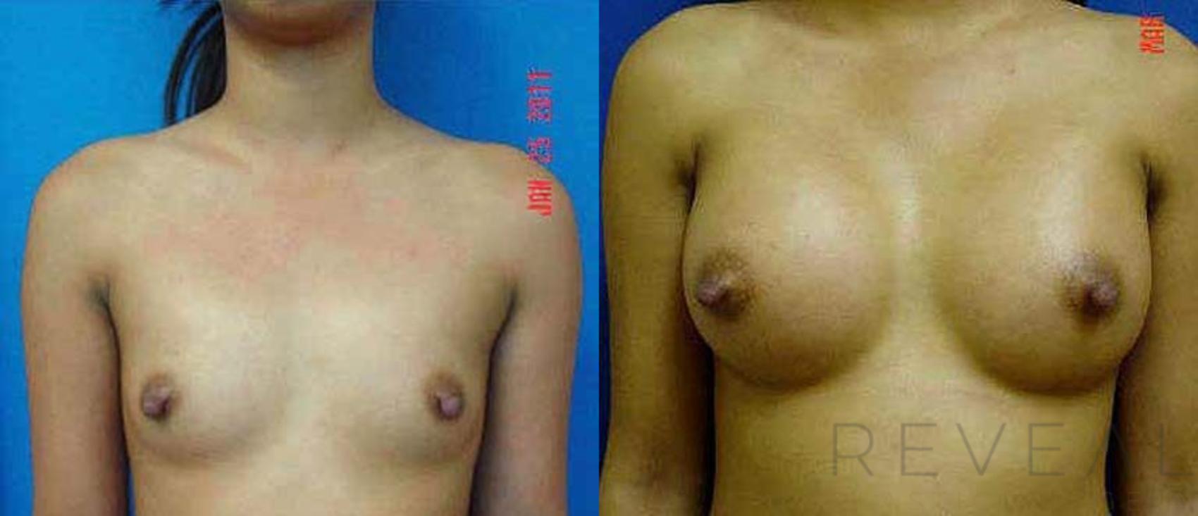 Before & After Breast Augmentation Case 59 View #1 View in San Jose, CA