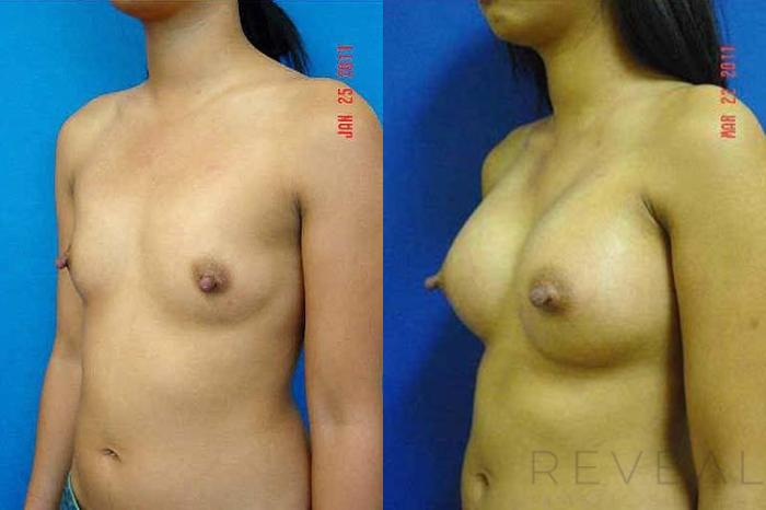Before & After Breast Augmentation Case 59 View #2 View in San Jose, CA
