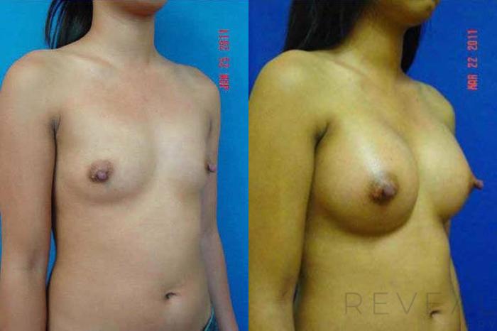 Before & After Breast Augmentation Case 59 View #3 View in San Jose, CA