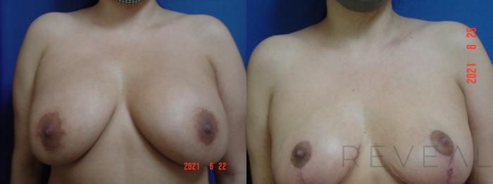 Before & After Breast Augmentation Case 590 View #1 View in San Jose, CA