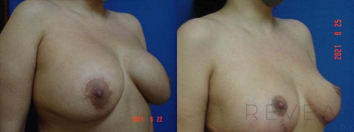 Before & After Breast Lift Case 590 View #2 View in San Jose, CA