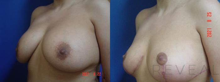 Before & After Breast Augmentation Case 590 View #3 View in San Jose, CA