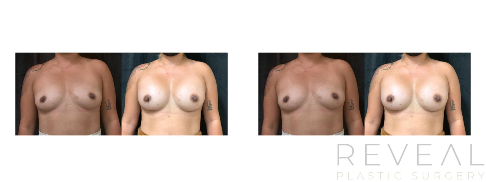 Before & After Breast Augmentation Case 594 Front View in San Jose, CA