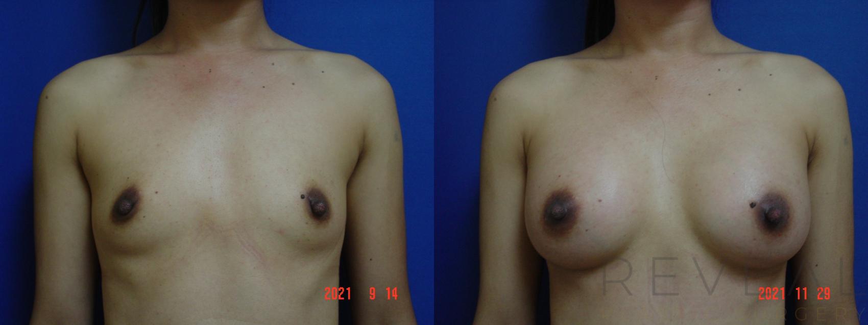 Before & After Breast Augmentation Case 596 Front View in San Jose, CA