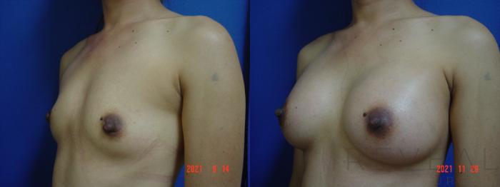 Before & After Breast Implants Case 596 Left Oblique View in San Jose, CA