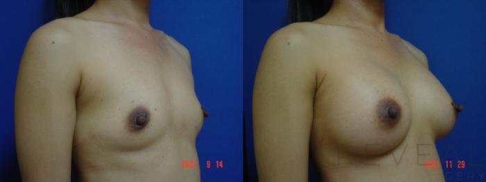 Before & After Breast Augmentation Case 596 Right Oblique View in San Jose, CA