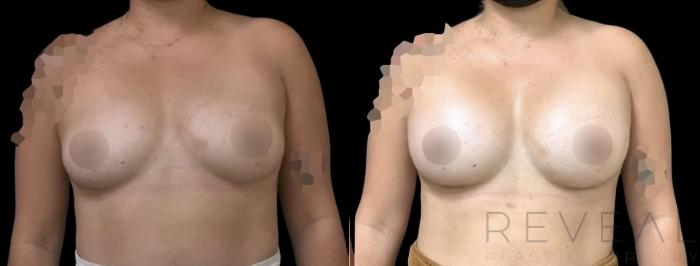 Before & After Breast Augmentation Case 598 Front View in San Jose, CA