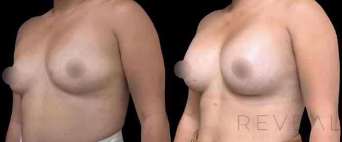 Before & After Breast Augmentation Case 598 Right Oblique View in San Jose, CA
