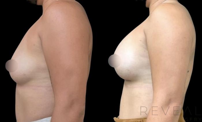 Before & After Breast Augmentation Case 598 Right Side View in San Jose, CA