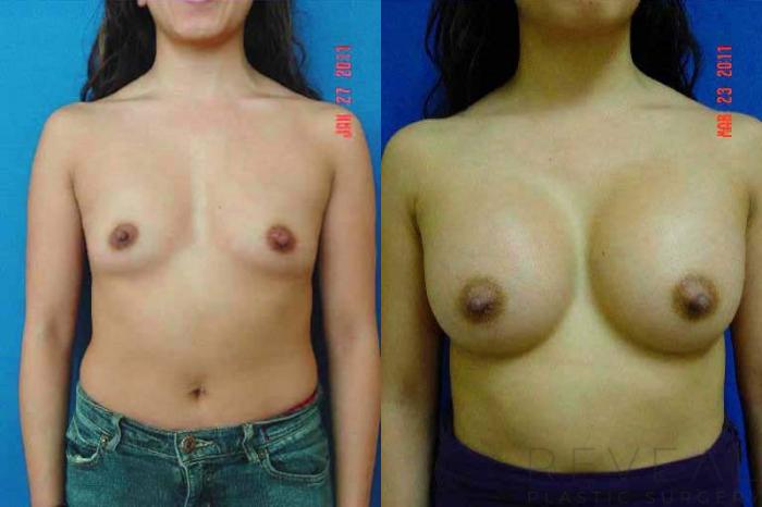 Before & After Breast Augmentation Case 60 View #1 View in San Jose, CA