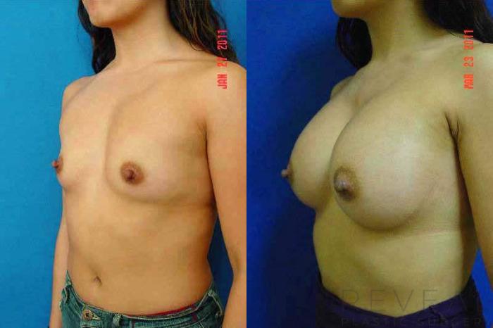 Before & After Breast Augmentation Case 60 View #2 View in San Jose, CA