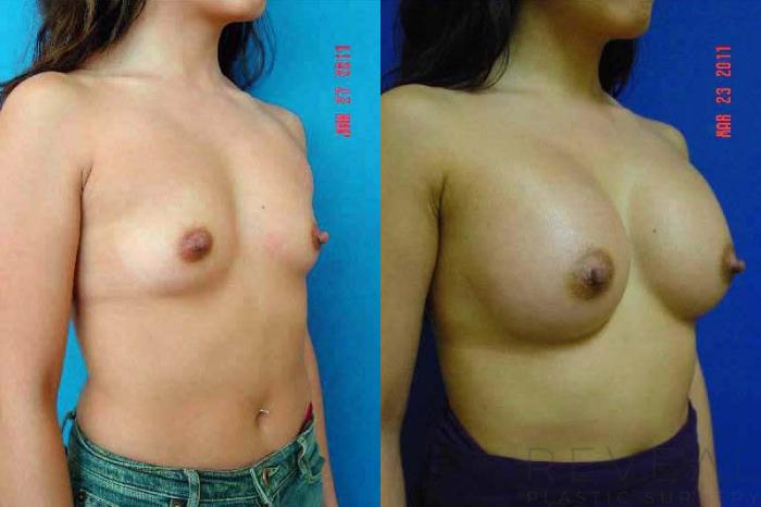 Before & After Breast Augmentation Case 60 View #3 View in San Jose, CA