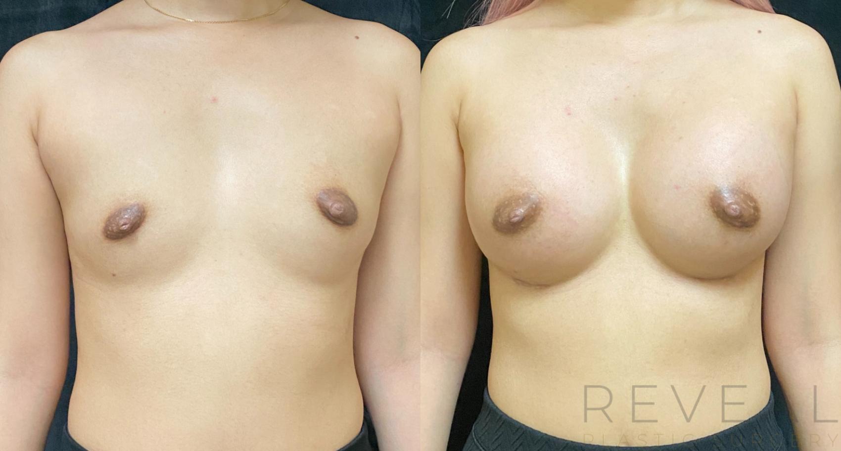 Before & After Breast Augmentation Case 602 Front View in San Jose, CA