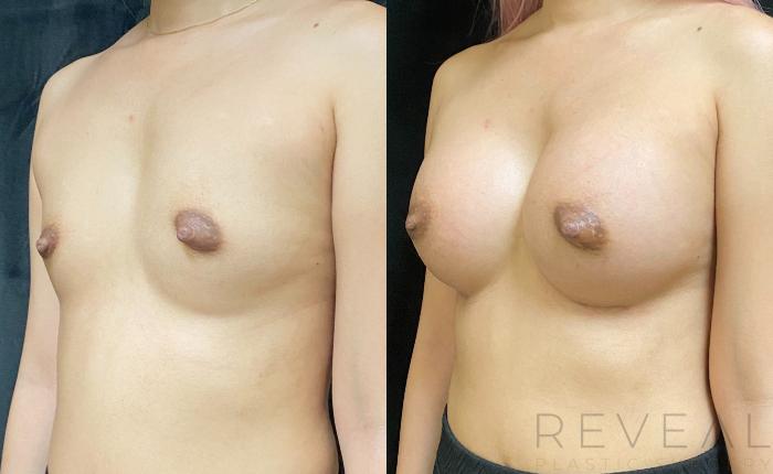 Before & After Breast Augmentation Case 602 Left Side View in San Jose, CA