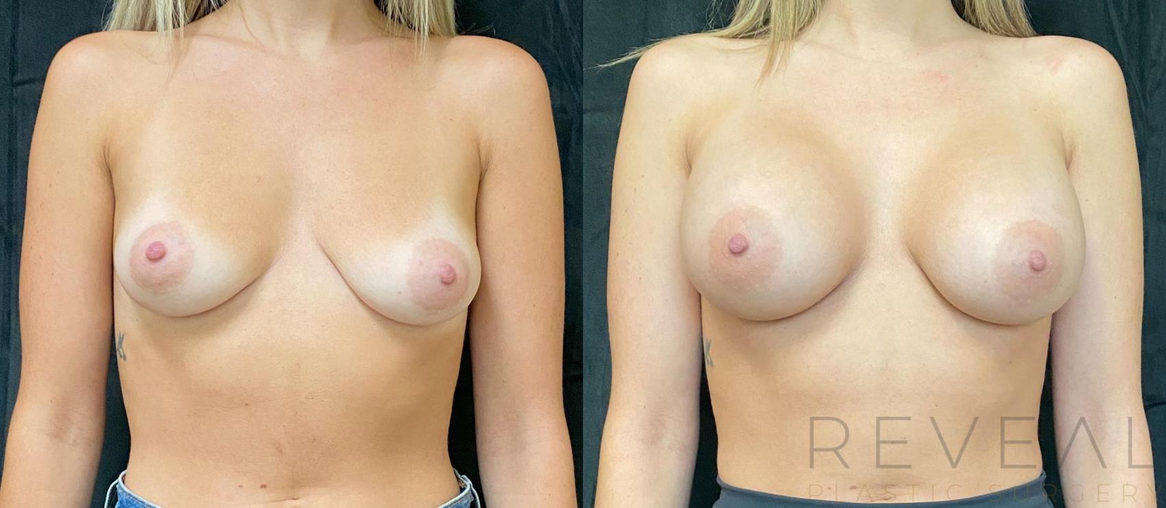 Before & After Breast Augmentation Case 604 Front View in San Jose, CA