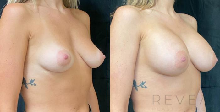 Before & After Breast Implants Case 604 Right Oblique View in San Jose, CA