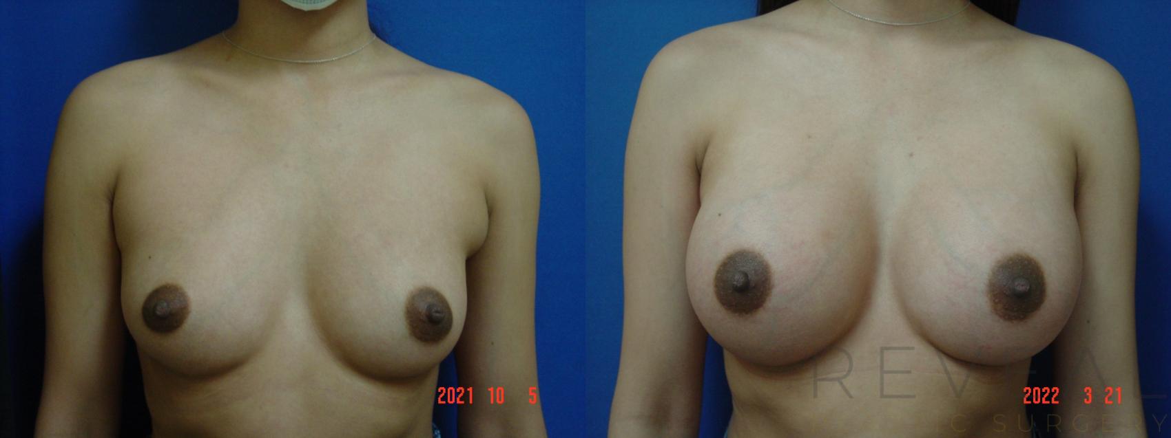 Before & After Breast Augmentation Case 610 Front View in San Jose, CA