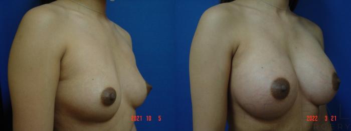 Before & After Breast Augmentation Case 610 Left Side View in San Jose, CA