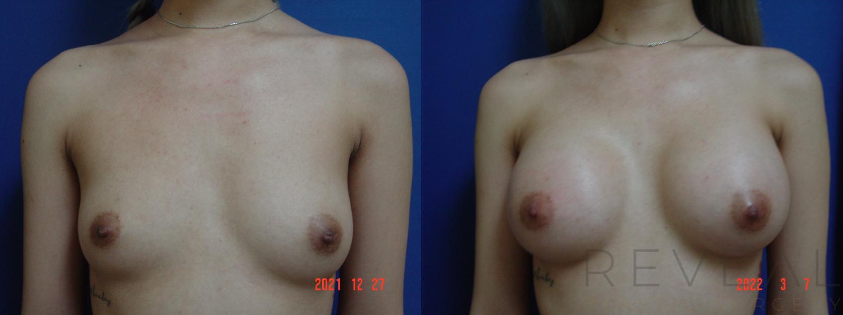 Before & After Breast Augmentation Case 611 Front View in San Jose, CA