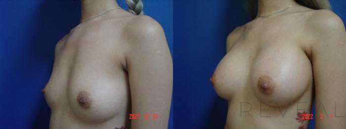 Before & After Breast Augmentation Case 611 Left Side View in San Jose, CA