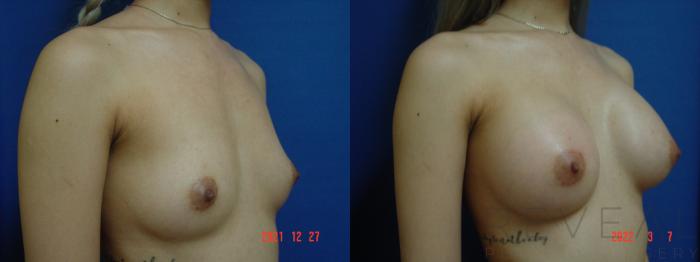 Before & After Breast Augmentation Case 611 Right Oblique View in San Jose, CA