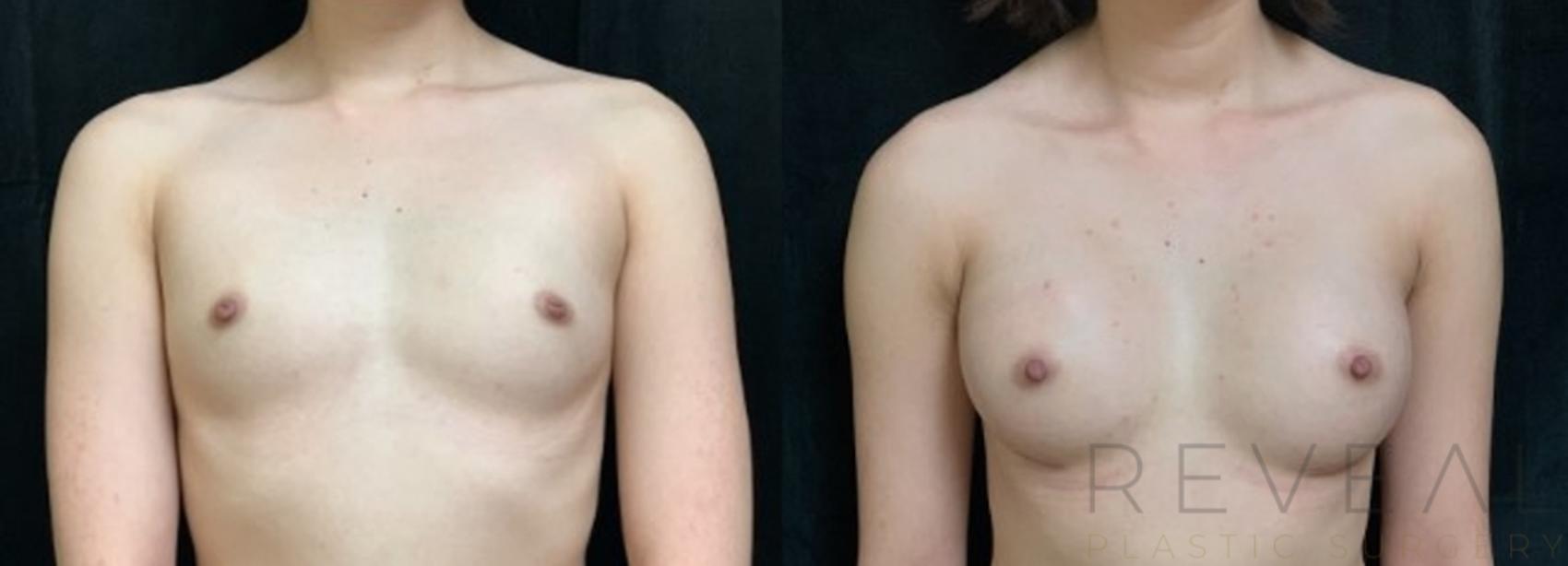 Before & After Breast Augmentation Case 614 Front View in San Jose, CA