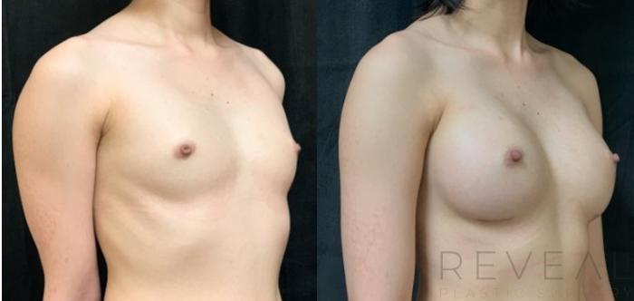Before & After Breast Augmentation Case 614 Left Oblique View in San Jose, CA