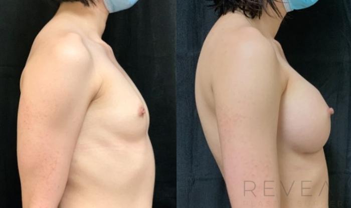 Before & After Breast Augmentation Case 614 Left Side View in San Jose, CA