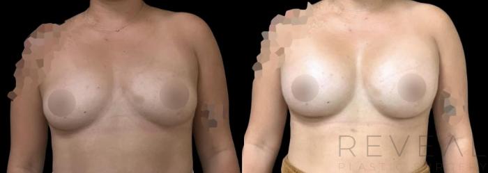 Before & After Breast Augmentation Case 615 Front View in San Jose, CA