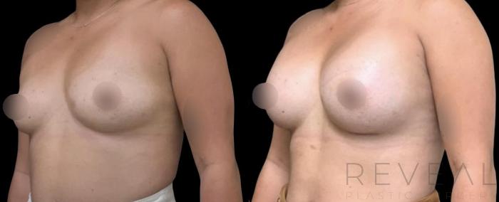 Before & After Breast Augmentation Case 615 Left Oblique View in San Jose, CA