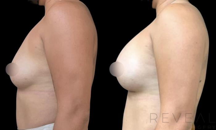 Before & After Breast Augmentation Case 615 Left Side View in San Jose, CA