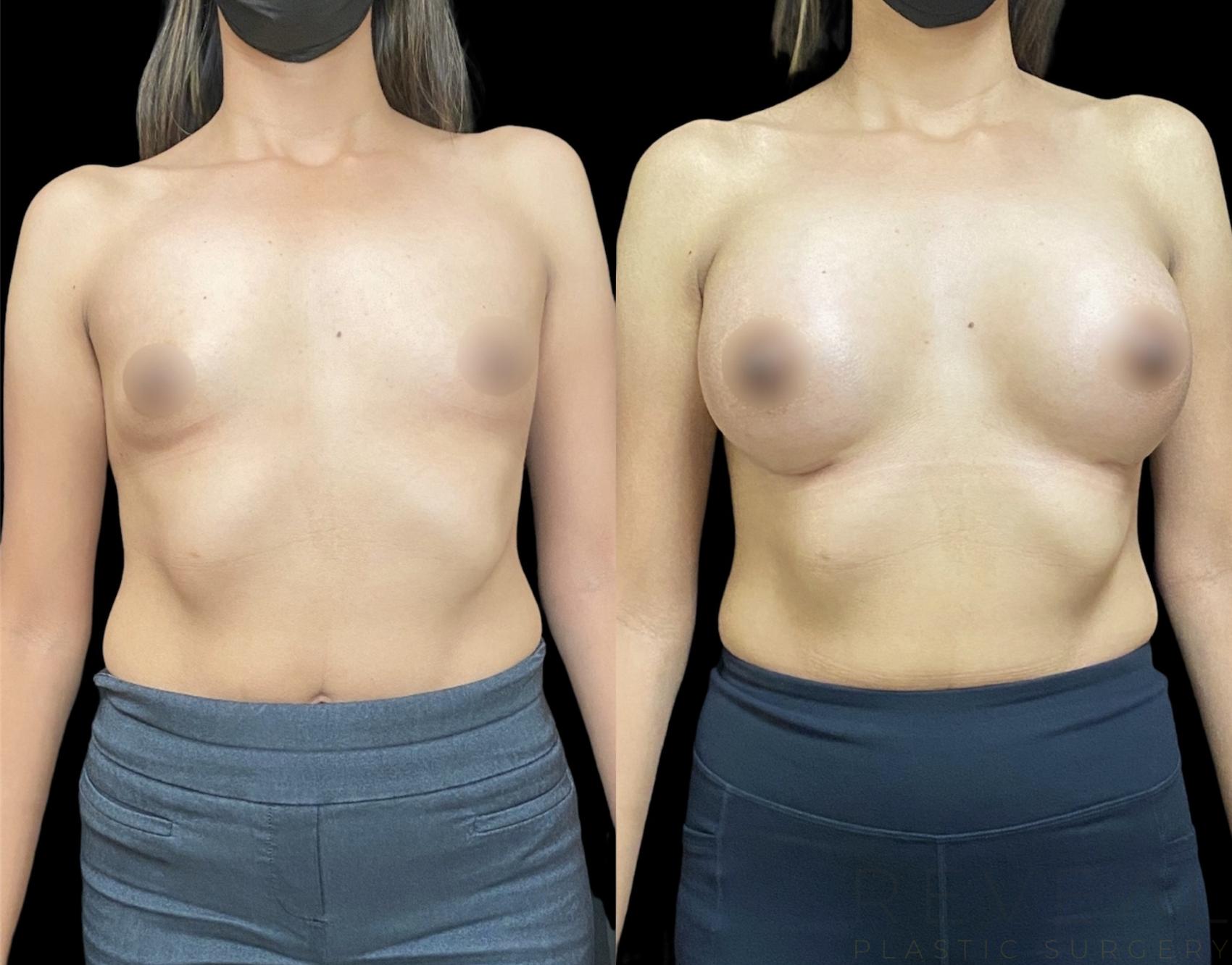 Before & After Breast Augmentation Case 617 Front View in San Jose, CA