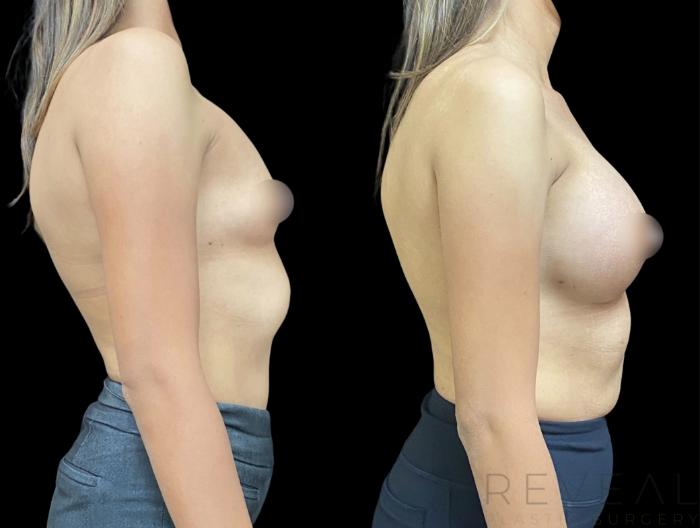 Before & After Breast Augmentation Case 617 Left Side View in San Jose, CA