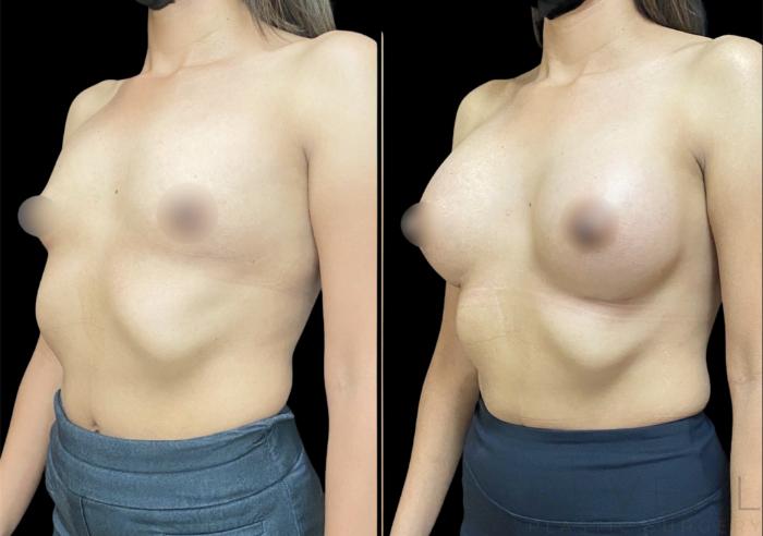 Before & After Breast Augmentation Case 617 Right Oblique View in San Jose, CA