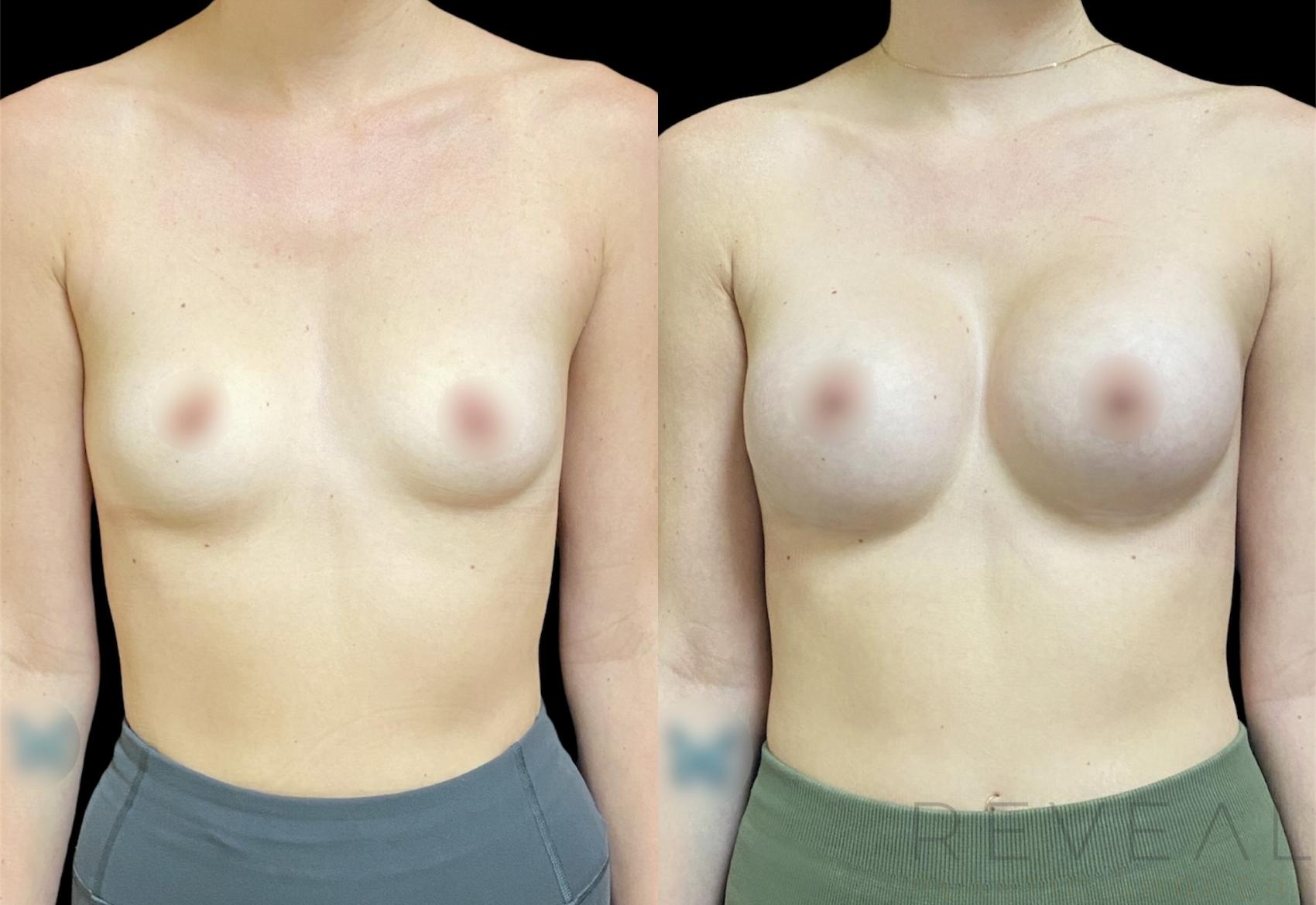 Before & After Breast Augmentation Case 619 Front View in San Jose, CA