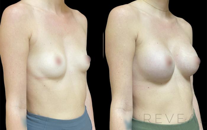 Before & After Breast Augmentation Case 619 Left Oblique View in San Jose, CA
