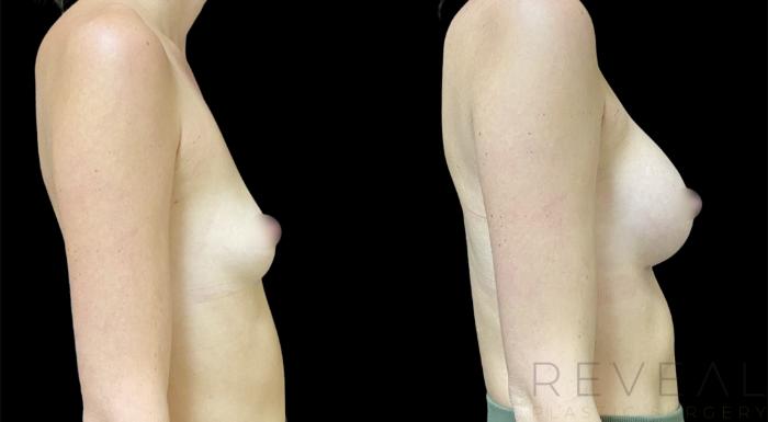 Before & After Breast Augmentation Case 619 Left Side View in San Jose, CA