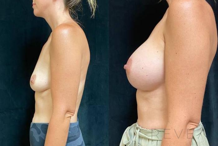 Before & After Breast Augmentation Case 622 Left Side View in San Jose, CA