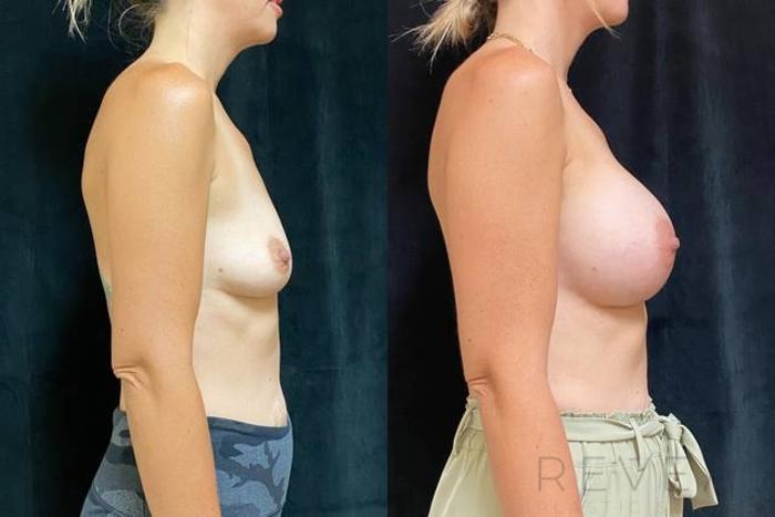 Before & After Breast Augmentation Case 622 Right Side View in San Jose, CA