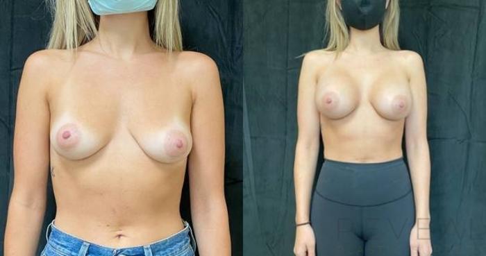 Before & After Breast Augmentation Case 624 Front View in San Jose, CA