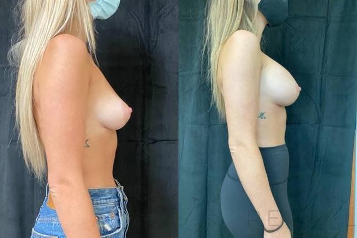 Before & After Breast Augmentation Case 624 Right Side View in San Jose, CA