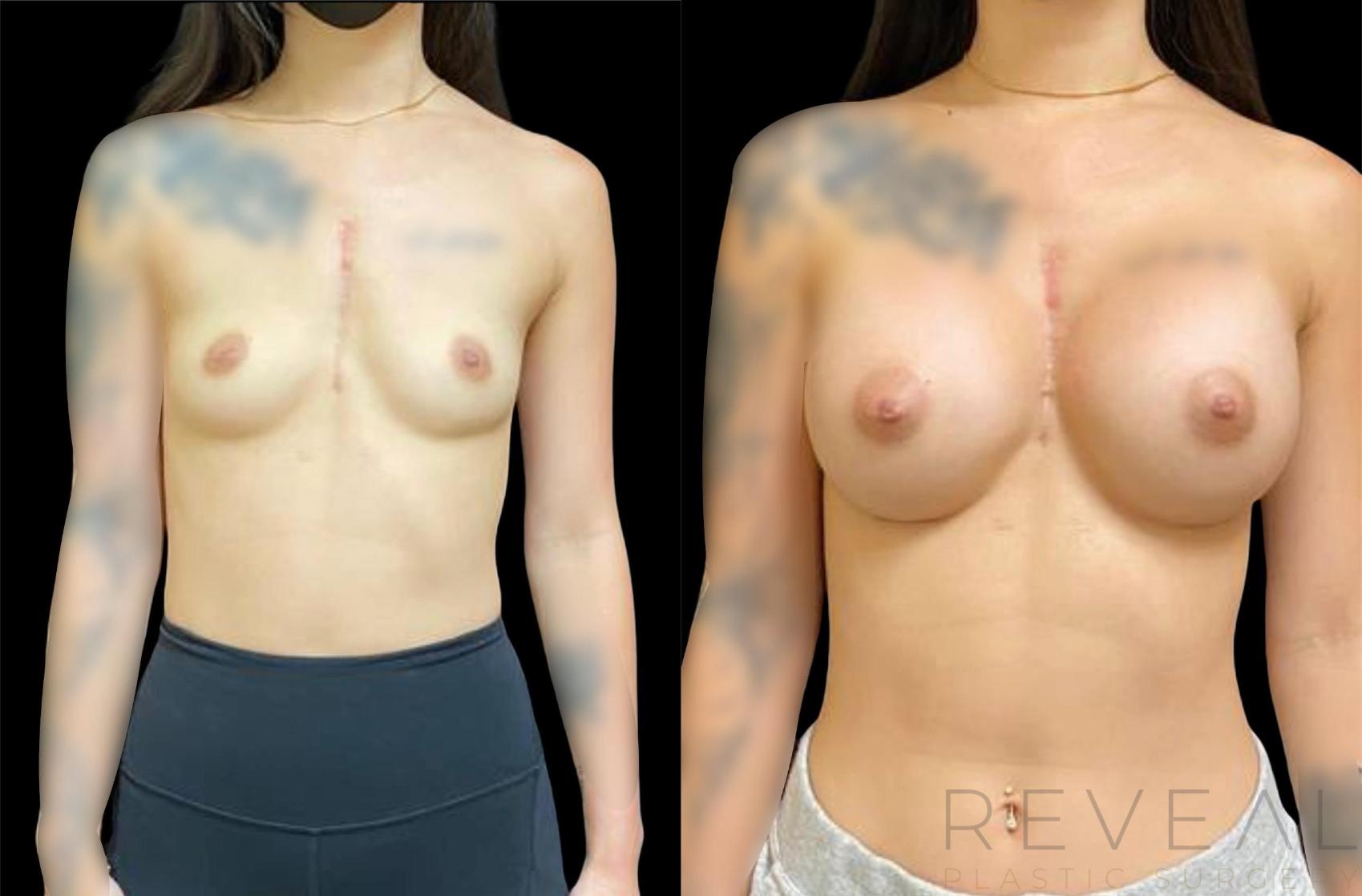 Before & After Breast Augmentation Case 628 Front View in San Jose, CA