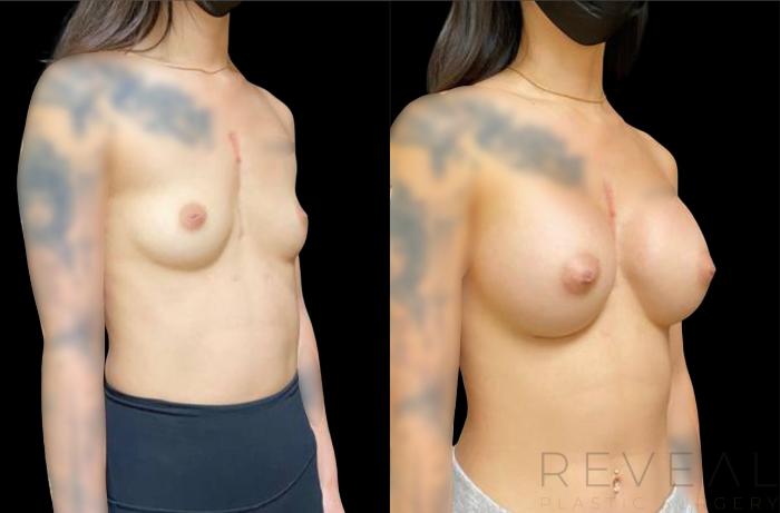 Before & After Breast Augmentation Case 628 Left Oblique View in San Jose, CA