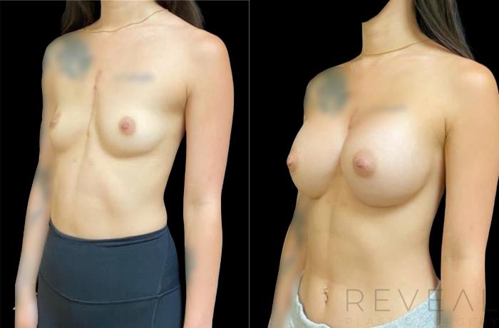 Before & After Breast Augmentation Case 628 Left Side View in San Jose, CA