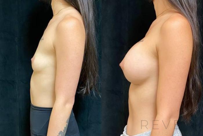 Before & After Breast Augmentation Case 628 Right Side View in San Jose, CA